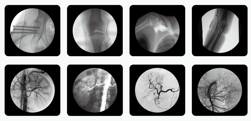 C型臂X光機PLX7000B拍攝臨床圖片