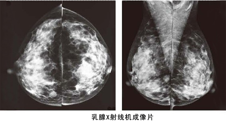 高頻鉬靶乳腺機(jī)