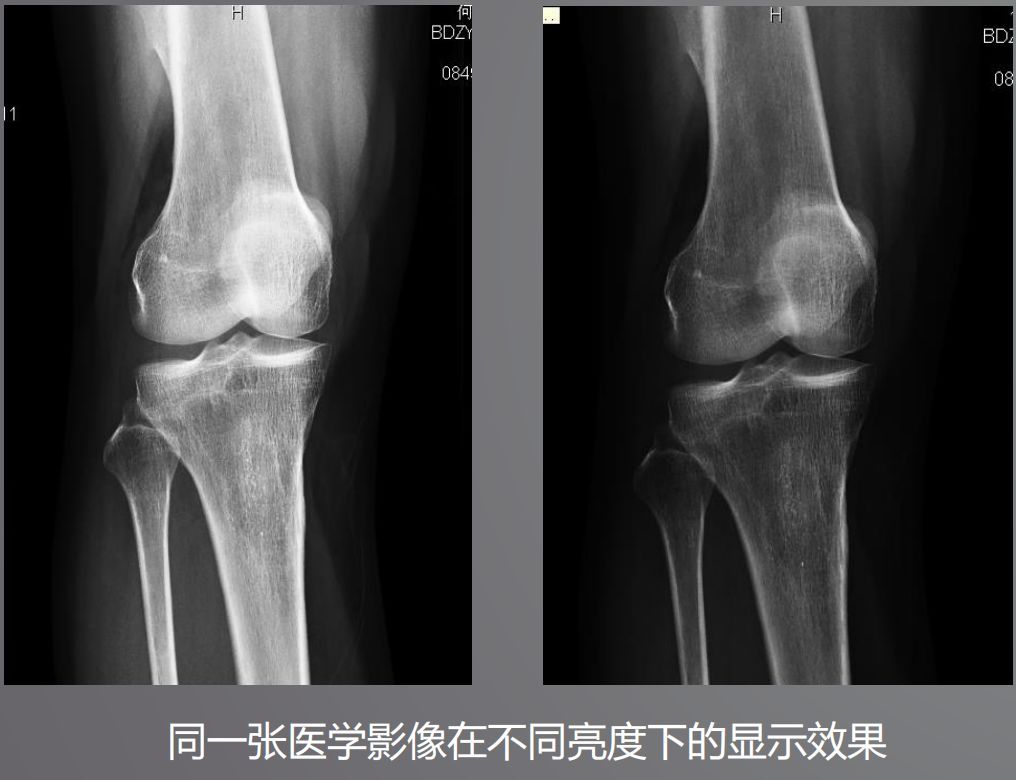 医用显示器与普通的有什么差别